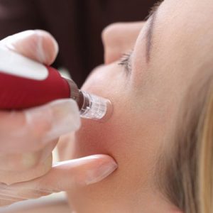 Microneedling
